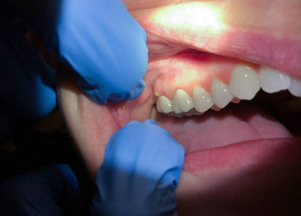Best Emergency Broken Tooth Repair in Rollingwood, TX